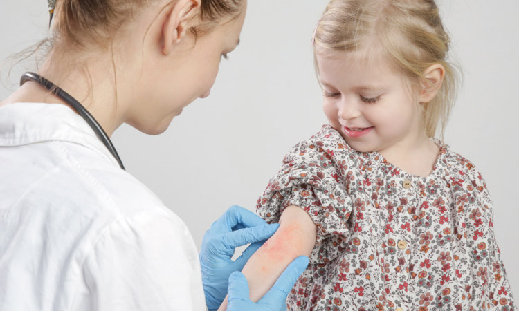 Ärztin behandelt rote und juckende Ekzeme auf dem Arm eines kleinen Mädchens
