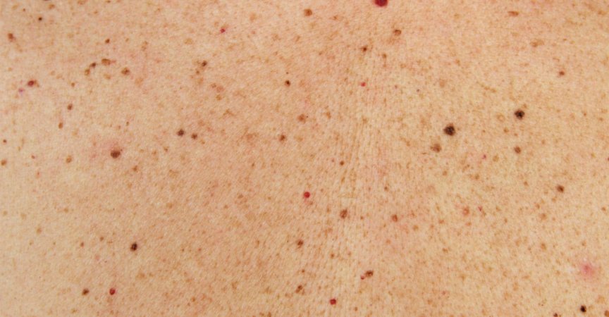 Auch kleinste Hautveränderungen erkennt der Züricher Ganzkörperscanner