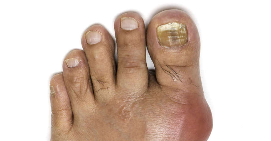 Fuß mit Gicht und Pilzzehennagel infiziert