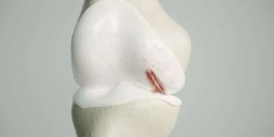 Leichte Arthrose am Kniegelenk - 3D-Rendering