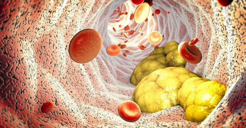 Cholesterinbildung, Fett, Arterie, Vene, Herz. Rote Blutkörperchen, Blutfluss. Verengung einer Vene zur Fettbildung