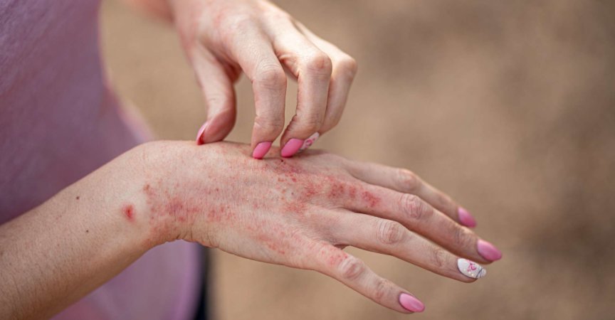 Ekzem Dermatitis an Händen und Füßen. rote Flecken auf der Haut. trockene HautDas Konzept Dermatologie, Behandlung von Pilzen. Frau kratzt sich an der Hand