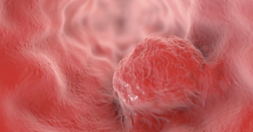 Speiseröhrenkrebs, 3D-Darstellung, die einen Tumor an der Wand der Speiseröhre zeigt