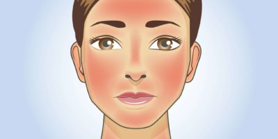 Hautrötungen erscheinen auf Gesicht und Hals der Frau durch Sonnenbrand. Illustration über die Gefahr von ultravioletter Strahlung.
