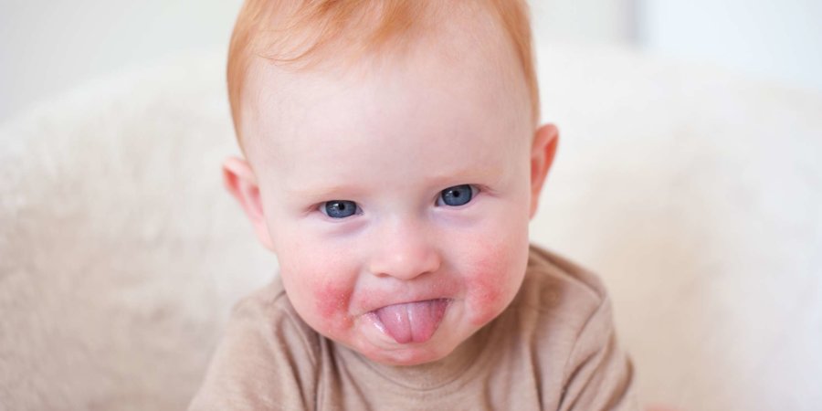 Ein Kind mit einer Allergie im Gesicht zeigt seine Zunge