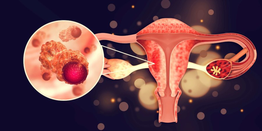 Erkrankungen des weiblichen Fortpflanzungssystems. Gebärmutterkrebs und bösartiger Tumor des Endometriums als uterines medizinisches Konzept. 3D-Darstellung