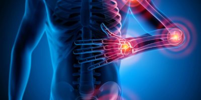 3D-Rendering - Starke Schmerzen in den Gelenken - Rheuma und Arthrose