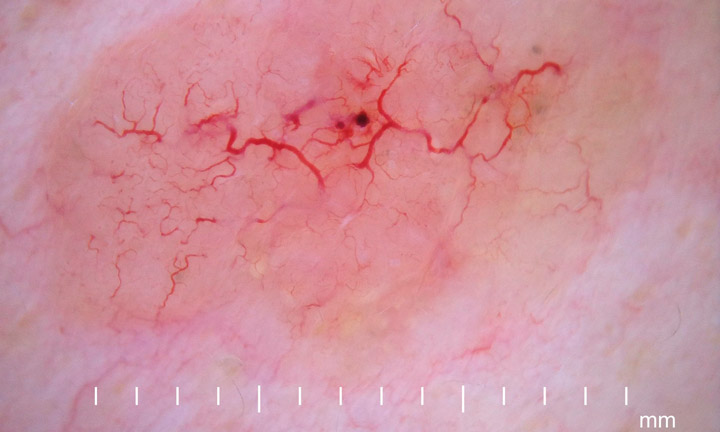 Dermatoskopie einesnodulären Basalzellkarzinoms