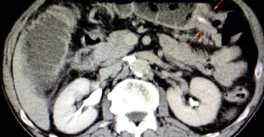 ein Computertomographie (CT)-Scan eines Patienten mit Karzinom in seinem Querkolon