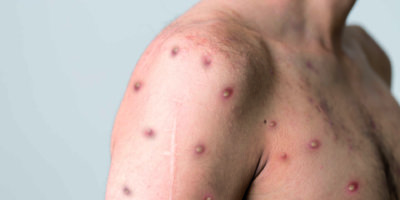 Monkeypox neue Krankheit gefährlich auf der ganzen Welt. Foto in hoher Qualität