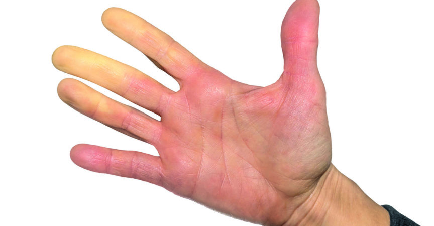 Weibliche Hand. Die Finger wurden aufgrund des Mangels an Durchblutung weiß (Blässe), was mit der Vasokonstriktion abnahm. Getrennt auf Weiß.