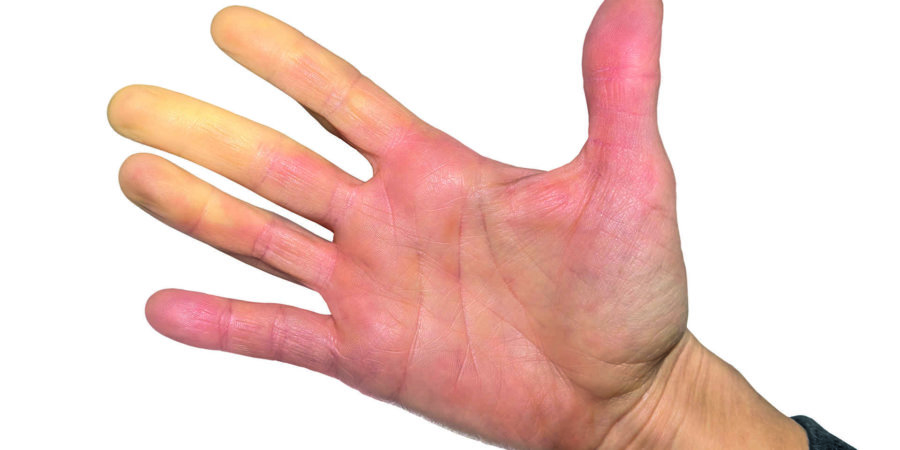 Weibliche Hand. Die Finger wurden aufgrund des Mangels an Durchblutung weiß (Blässe), was mit der Vasokonstriktion abnahm. Getrennt auf Weiß.