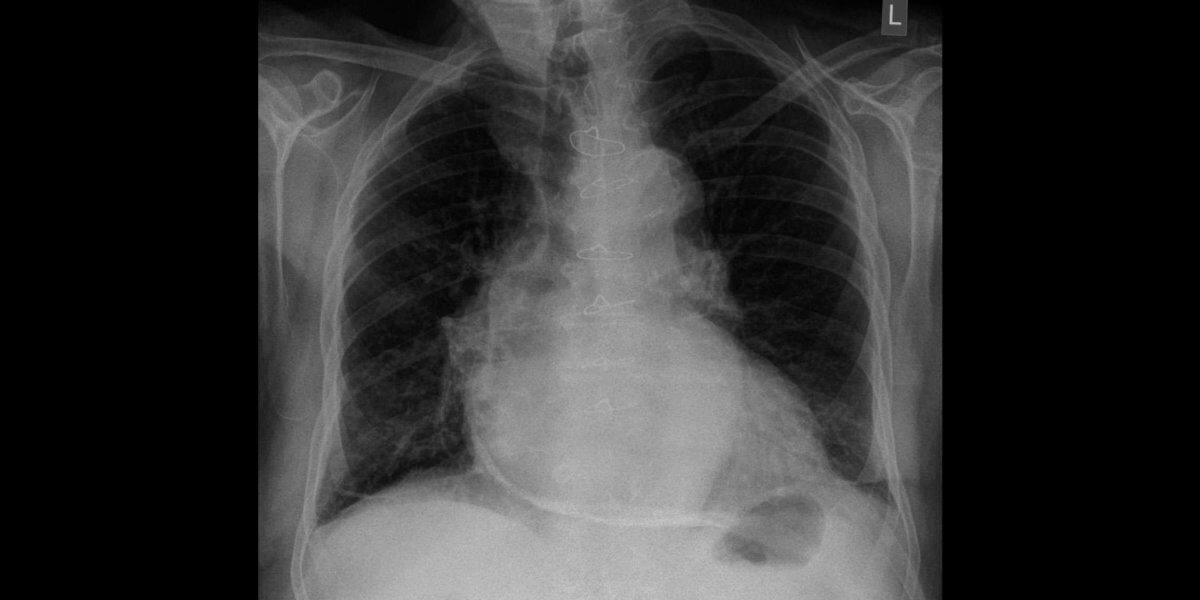 Seltene, aber typische Trias bei konstriktiver Perikarditis