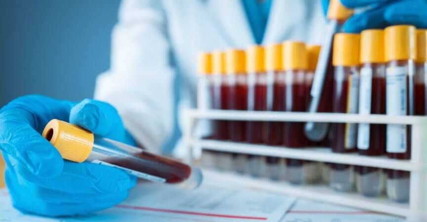 Bluttest, Blut, medizinische Probe, Reagenzglas