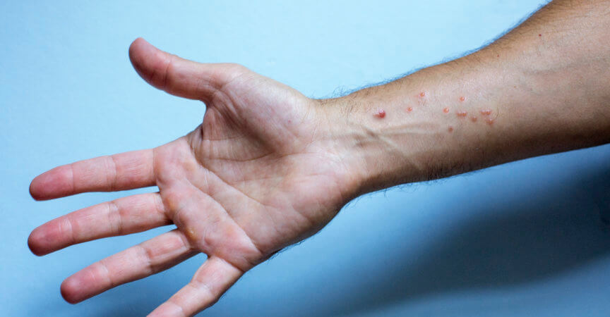 Unterarm eines Mannes mit Hautausschlag.Monkeypox-Virus-Symptome