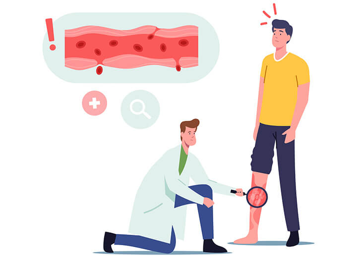 Themenbild Thrombose: Illustration Arzt untersucht Bein eines jungen Mannes mit Lupe