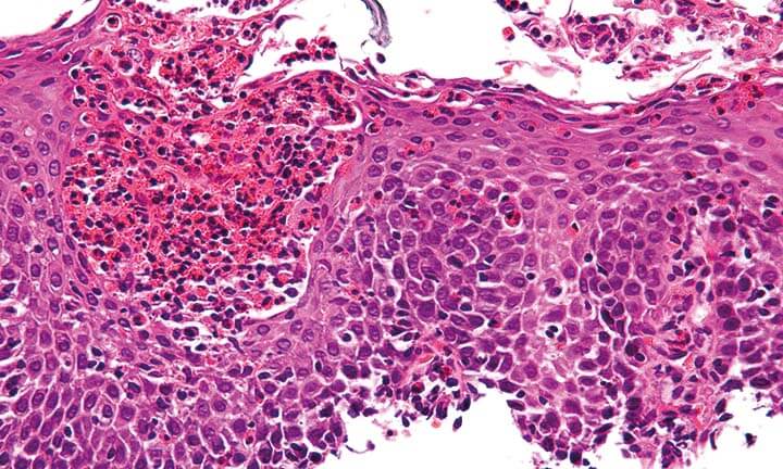 Die vielen Symptome der eosinophilen Ösophagitis