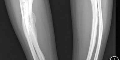 Röntgenbild zweier Beine Osteogenesis imperfectamit