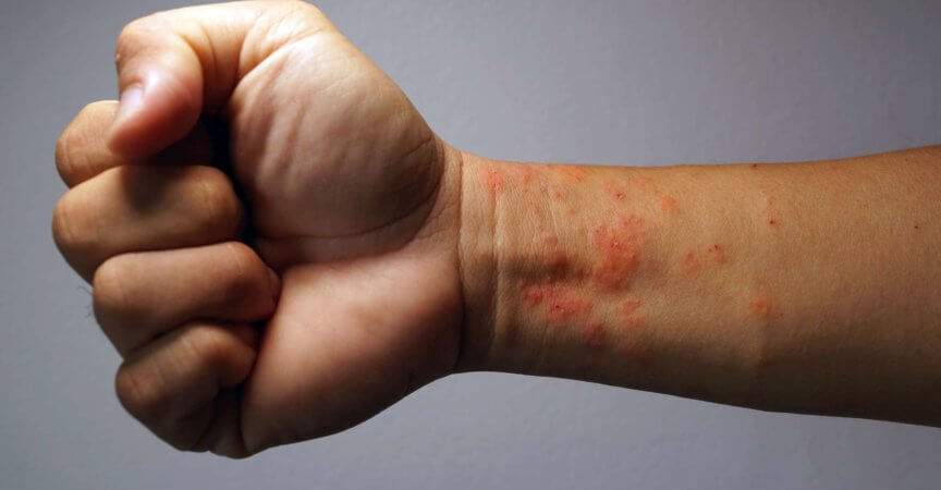 Medizinische atopische Ekzem-Allergie-Textur kranker menschlicher Haut