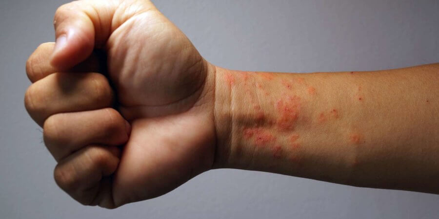 Medizinische atopische Ekzem-Allergie-Textur kranker menschlicher Haut