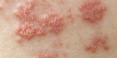Erhabene rote Beulen und Blasen, die durch das Gürtelrosevirus verursacht werden