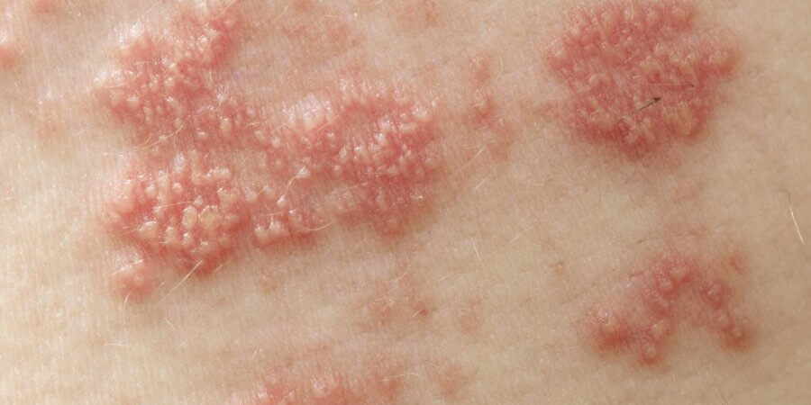 Erhabene rote Beulen und Blasen, die durch das Gürtelrosevirus verursacht werden
