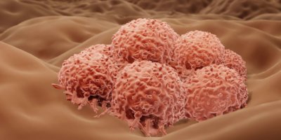 Hauttumor, Melanomzellen im menschlichen Körper