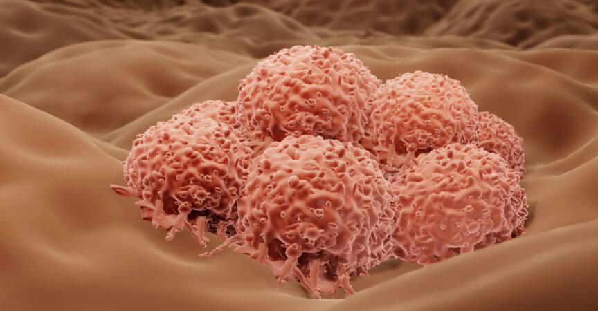 Hauttumor, Melanomzellen im menschlichen Körper