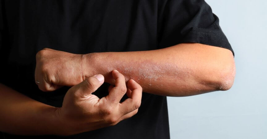 Spricht eine atopische Dermatitis nicht ausreichend auf topische Therapien an, muss systemisch behandelt werden.