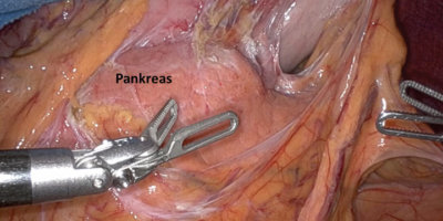 Chirurgischer Eingriff an der Pankreas mit Roboter-Technik