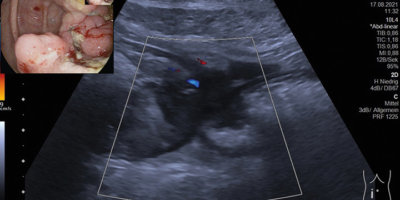 Ultraschall-Aufnahme eines kolorektalen Karzinoms