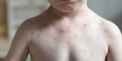 Hautausschläge bei Kindern sind zumeist harmlos, können aber auch ernstzunehmende Hintergründe haben.
