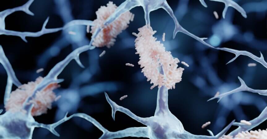 Amyloid-Plaques sind fehlgefaltete Proteinaggregate zwischen Neuronen, Illustration der Alzheimer-Krankheit