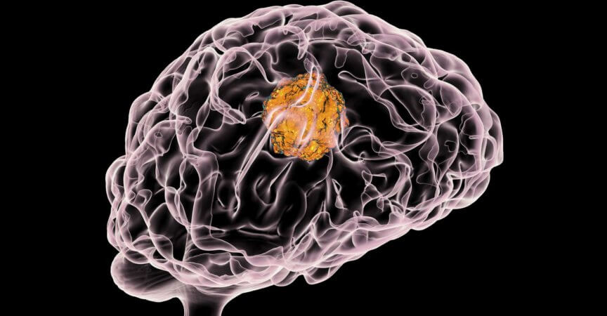 Hirntumor, 3D-Darstellung, die das Vorhandensein eines Tumors im Gehirn zeigt