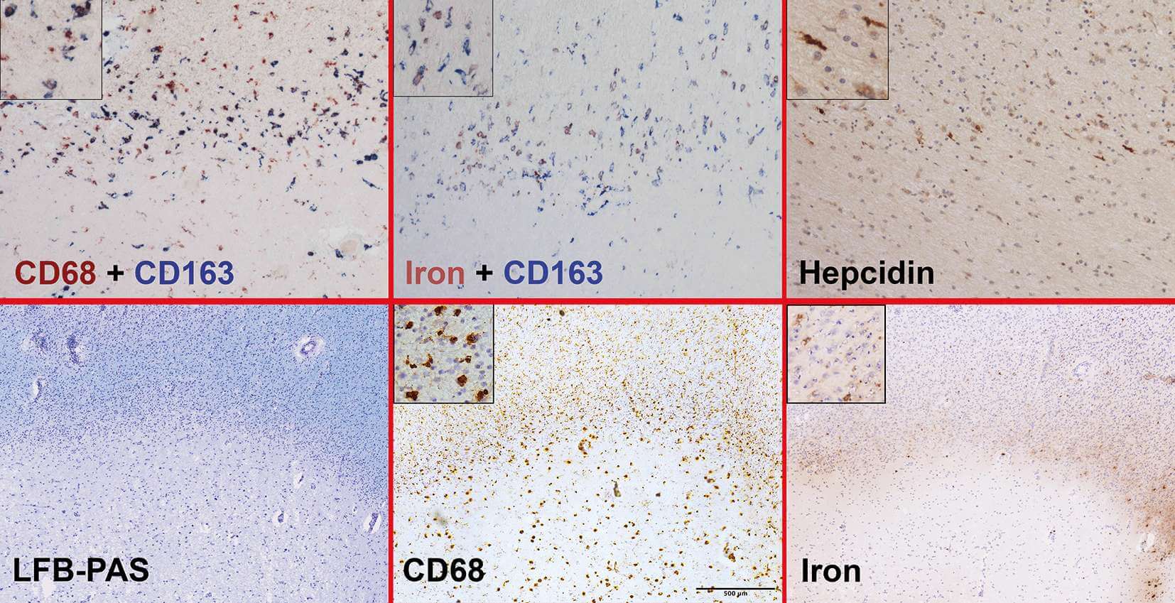Pathomechanismen der MSProgression