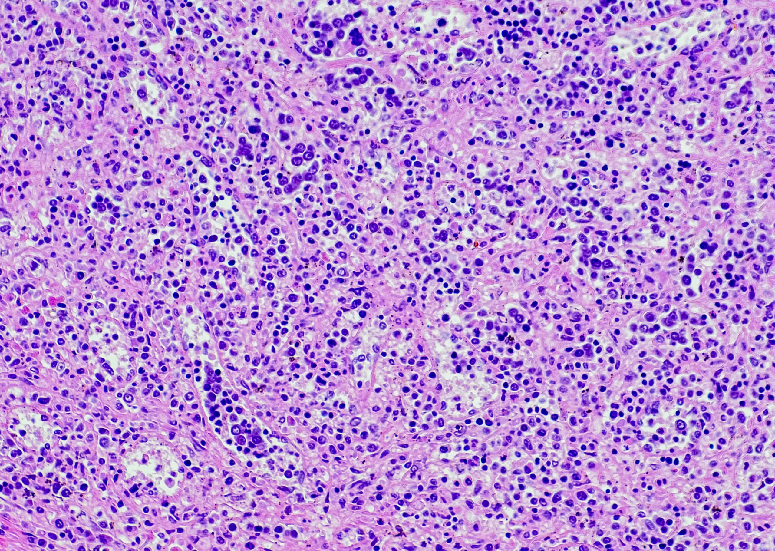 Neuer Erstlinienstandard beim klassischen HodgkinLymphom