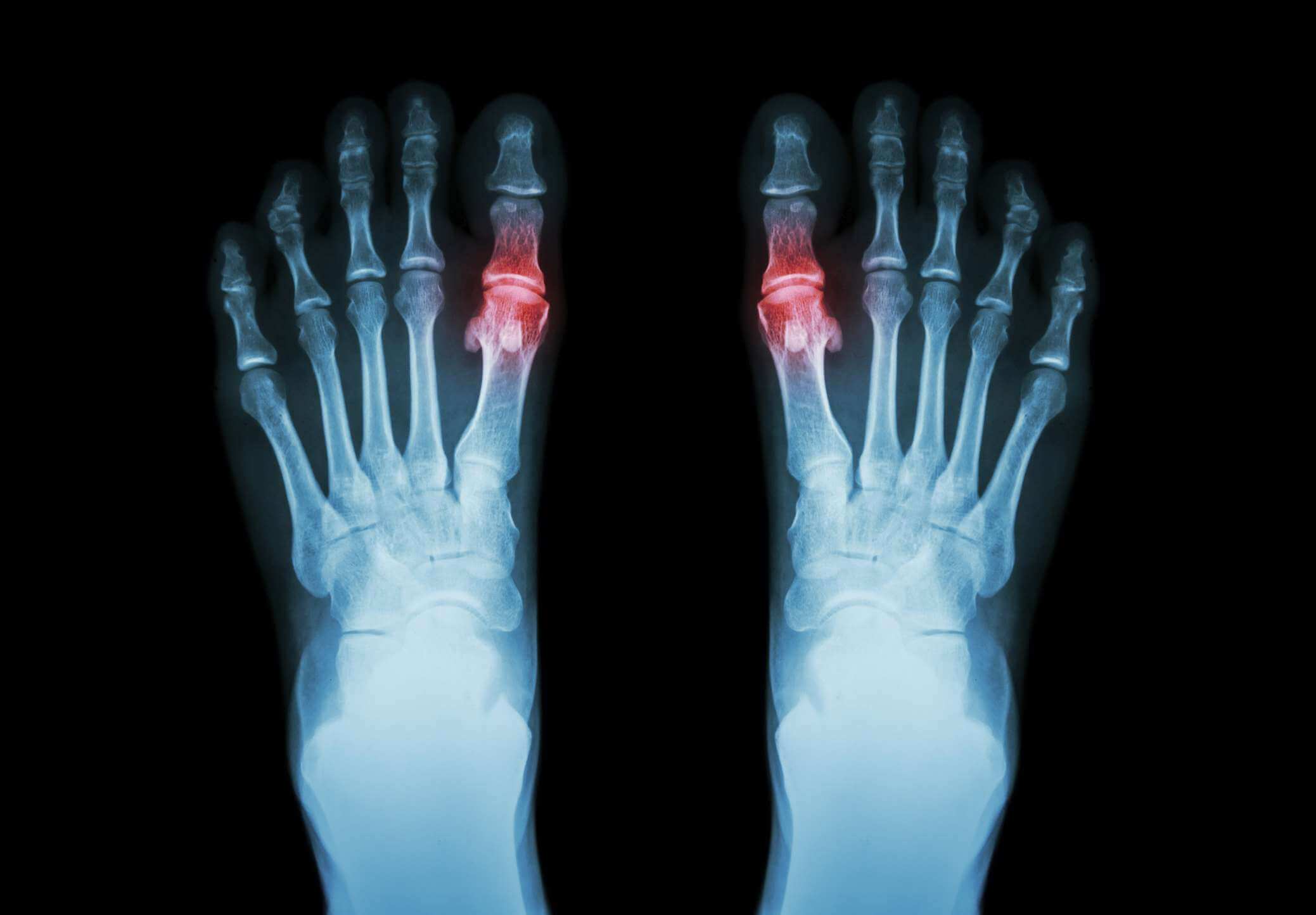 Imaging guidelines for gout and other crystalline joint diseases
