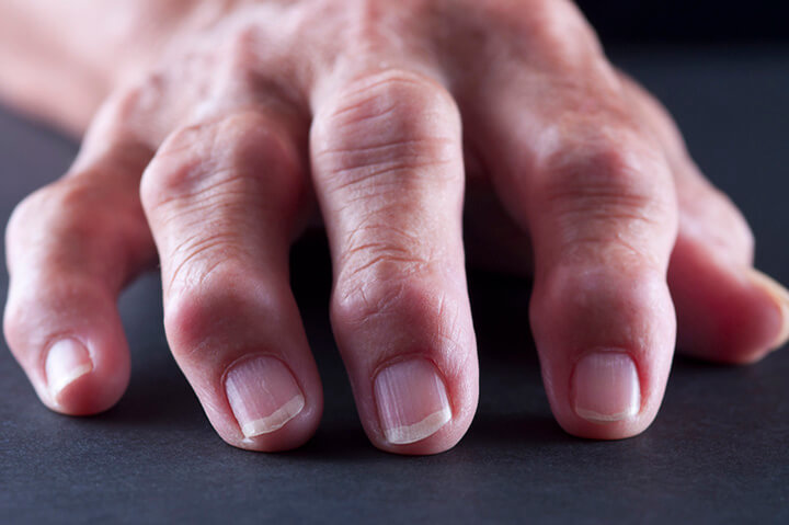 Selektivfokussiertes Bild der Hand eines arthritischen/älteren Erwachsenen, aufgenommen auf Schwarz
