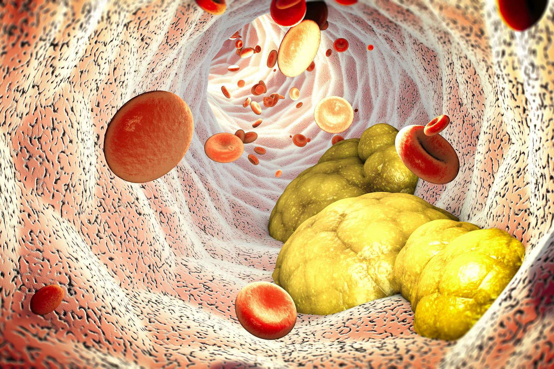 Lipide für die Mortalität wichtiger als Glukose