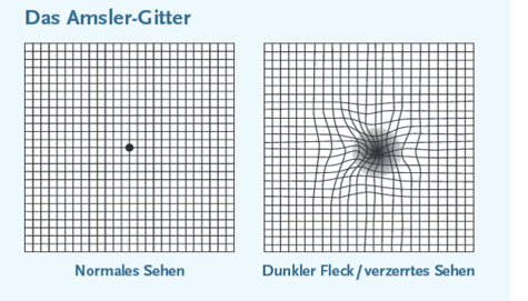 Visualisierung des Amsler Gitters als Schnelltest für Diabetiker.