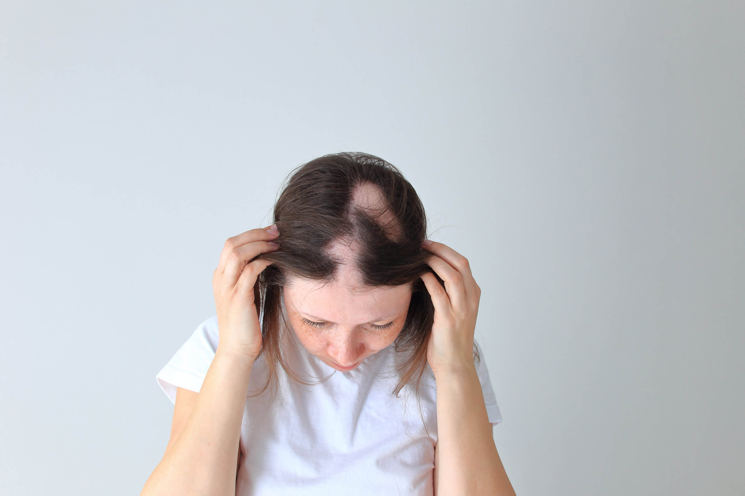 Herbal medicines with lasting effect on alopecia areata