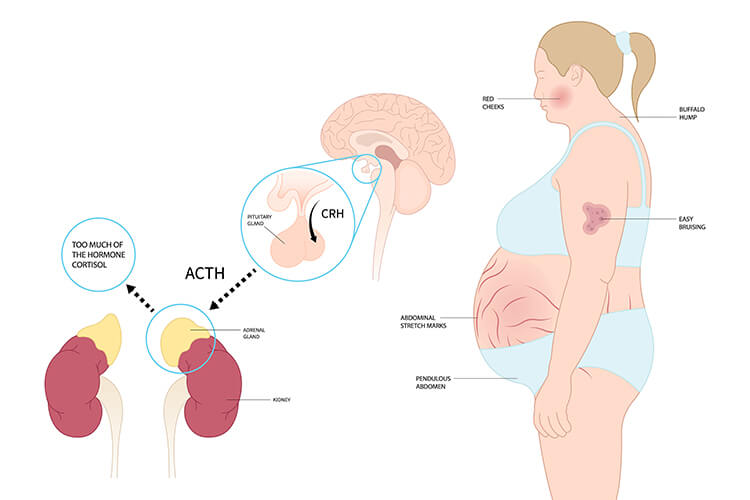 Wenn Kortisol Den K rper Flutet wenn-kortisol-den-k-rper-flutet