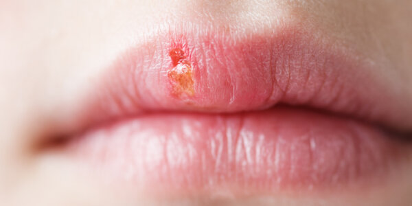 Weibliche Lippen mit Herpes
