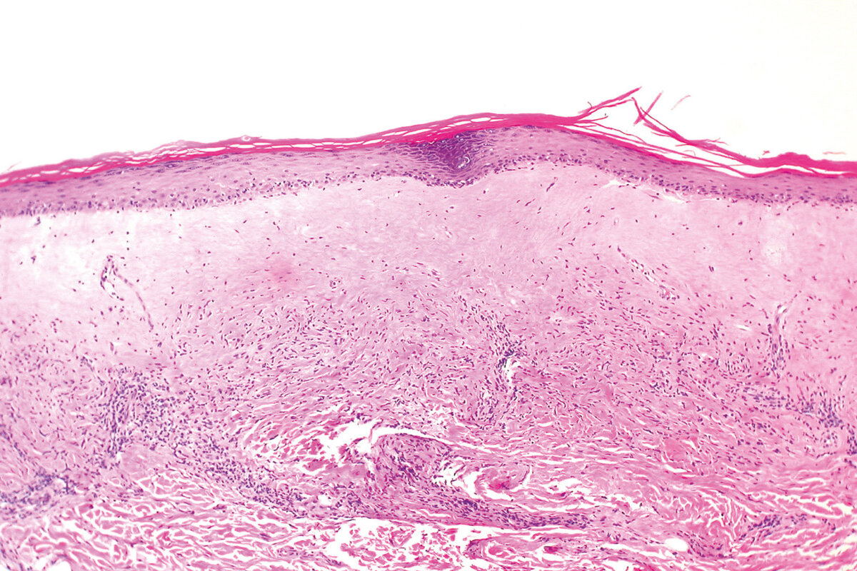 Lichen sclerosus: frühzeitige Diagnose erspart viel Leid