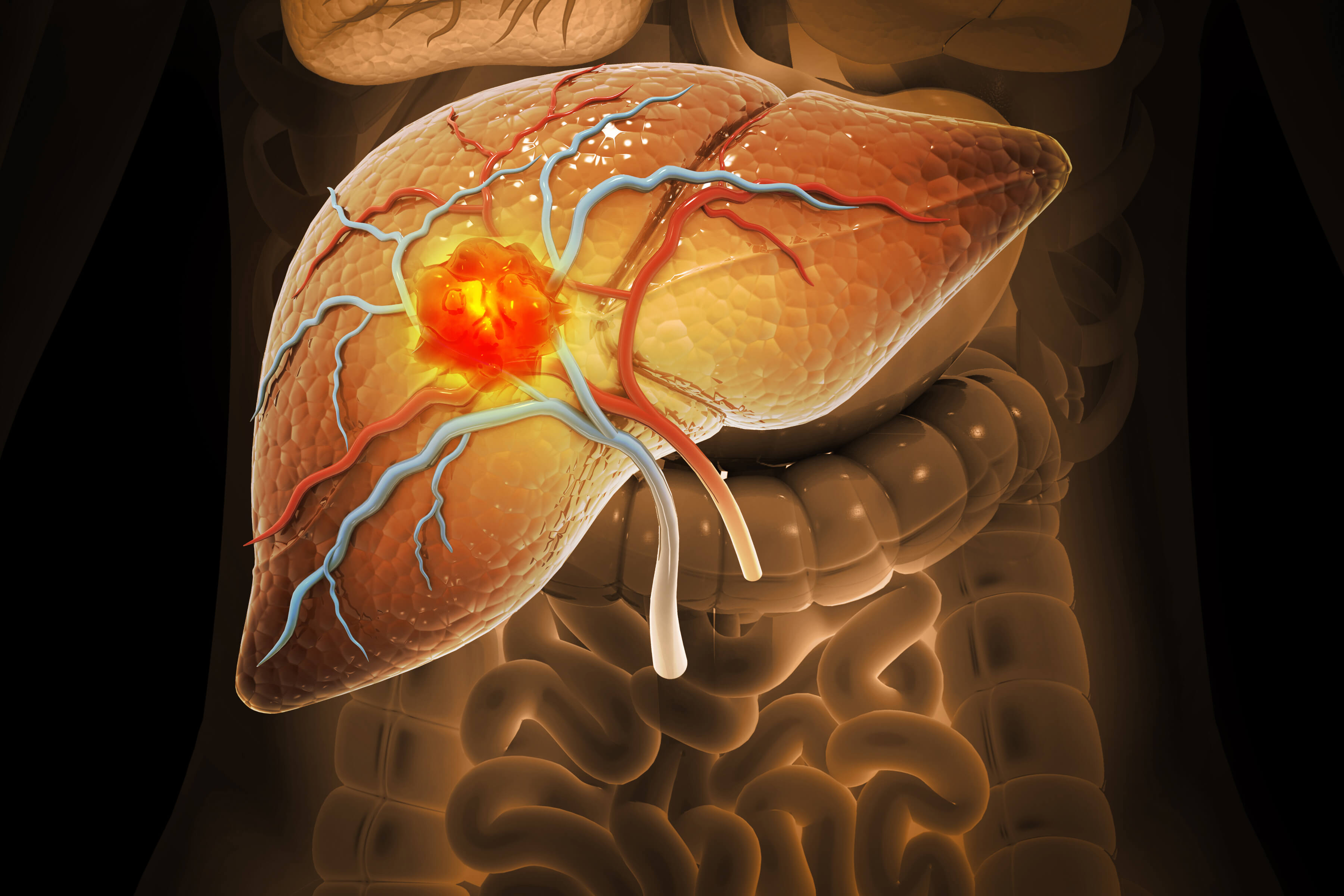 Complete Remission of Hepatocellular Carcinoma After B-Cell Depletion - News Directory 3