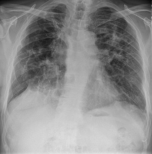 Röntgenaufnahmen der Lunge eines Sarkoidose Patienten.