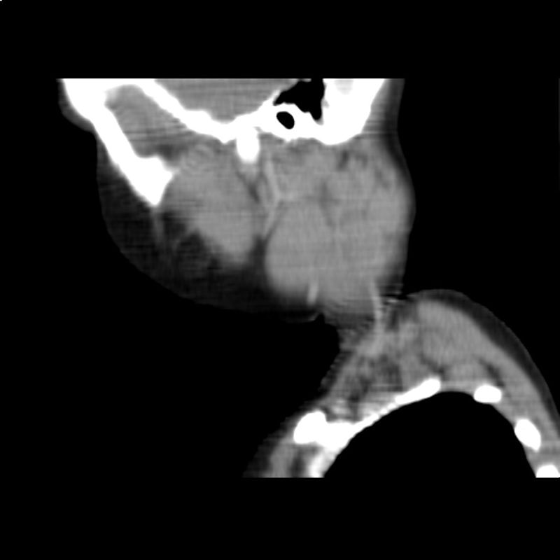 Computertomographie des Halses bei hochmalignem Non-Hodgkin-Lymphom der Halslymphknoten (rekonstruierter Sagittalschnitt).