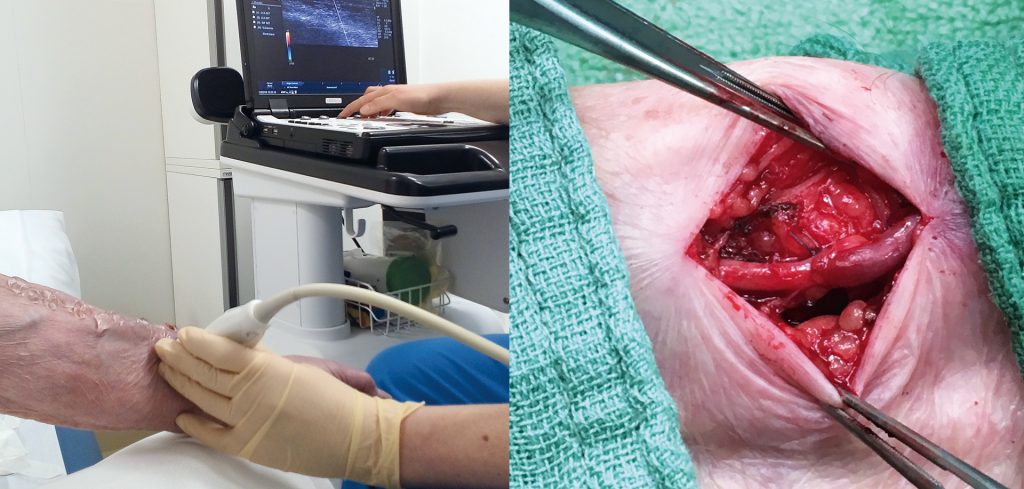 Fotos: Wiener KAV/Wilhelminenspital li: Präoperative Untersuchung und Planung re: Distaler radio-cephaler Shunt (Cimino-Shunt)