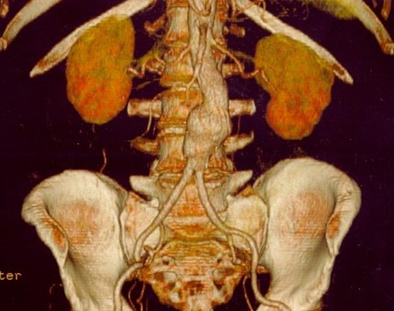 Der gesundheitspolitische Wert des Aortenaneurysmascreenings CliniCum