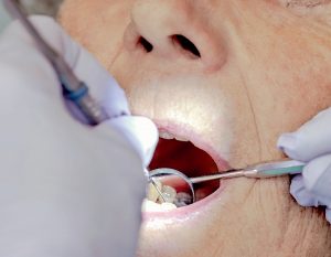 Steht eine Zahnextraktion an, ist das keine Indikation für ein Absetzen der Antikoagulation. Das Gleiche gilt auch für Endoskopien.